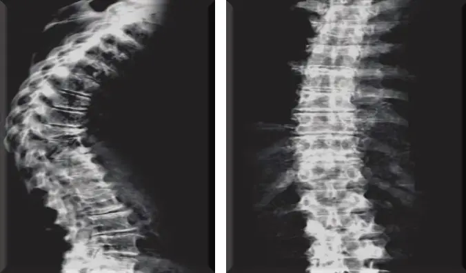 Densitometria Óssea – Clinoson