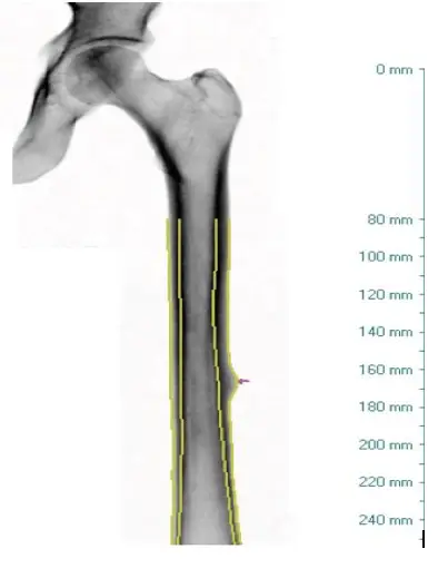 Densitometria Óssea – Clinoson